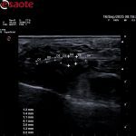 ecografía neuroma de morton