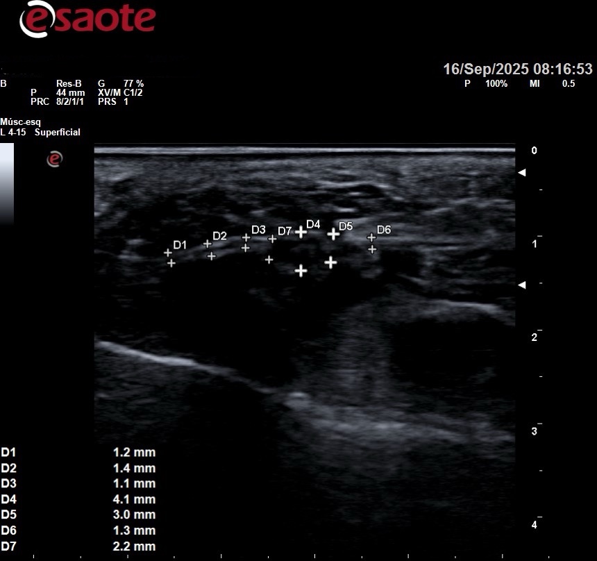 ecografía neuroma de morton