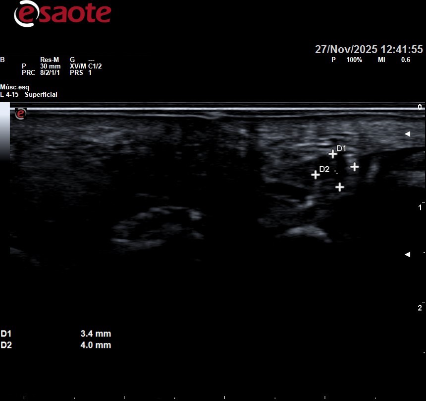 neuroma morton santander