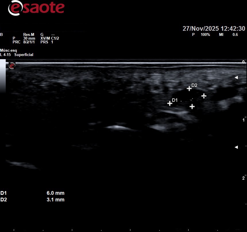 neuroma de morton diagnóstico