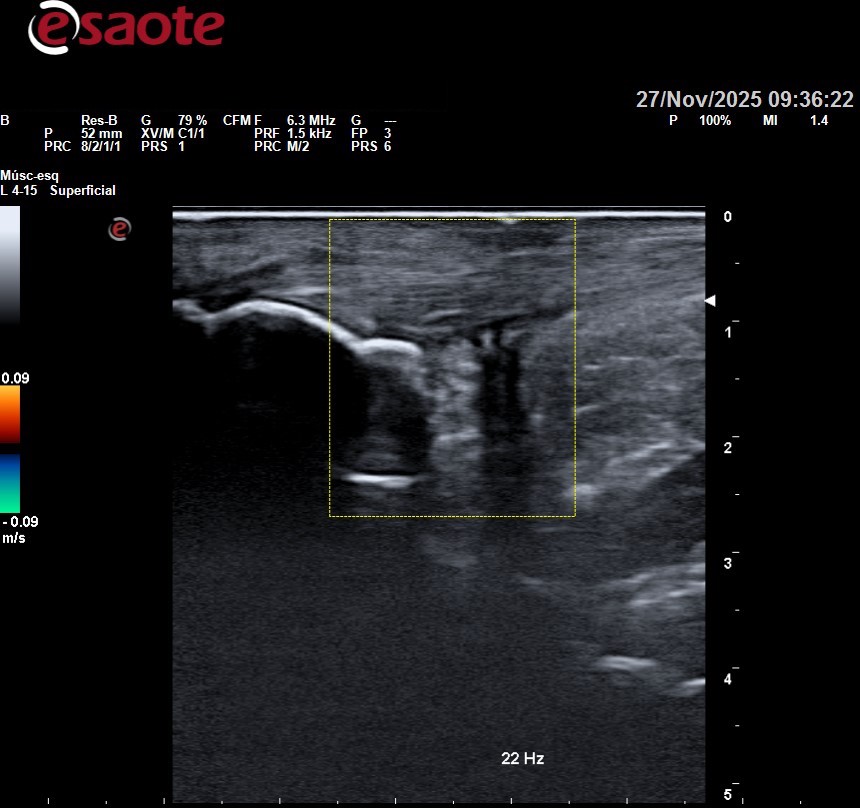 tendon de aquiles lesionado