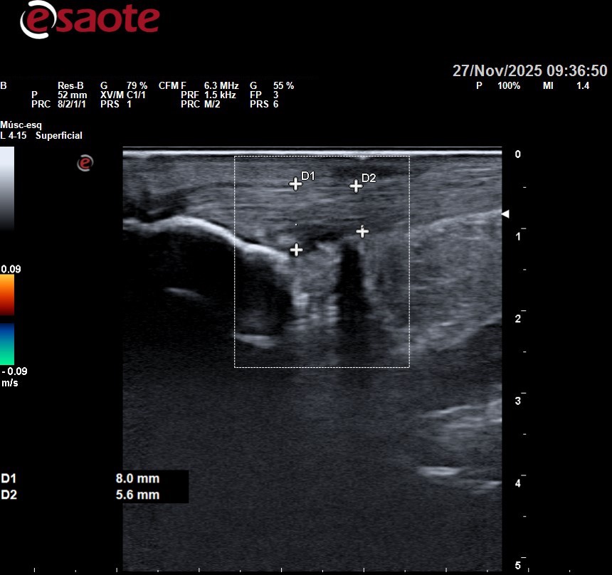 Lesión en tendón de aquiles importante. Podólogo en santander