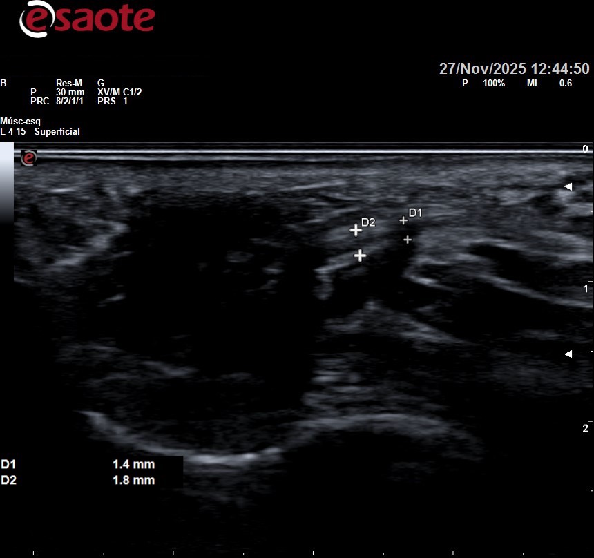 Neuroma de morton visto a lo largo