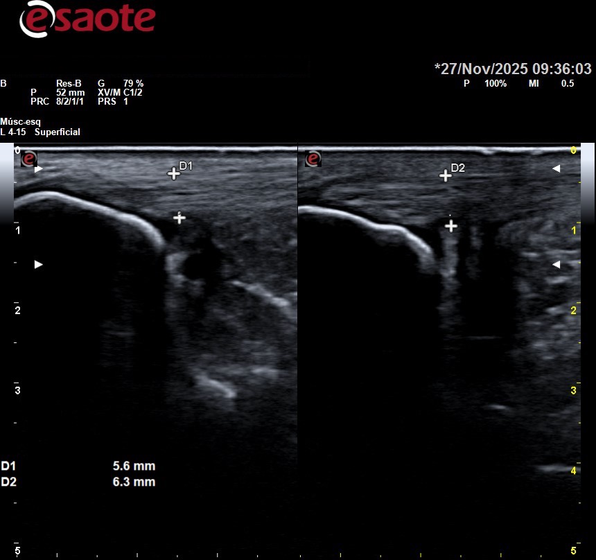 Tendón de aquiles inflamado