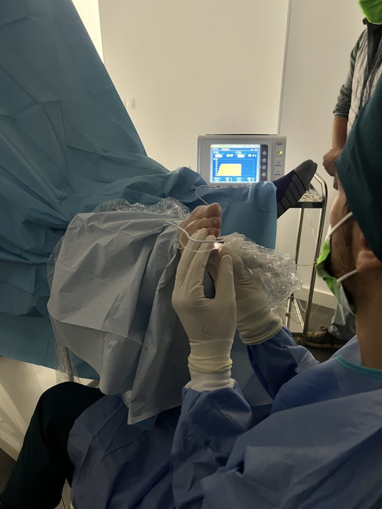 rizolisis para neuroma de morton