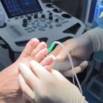 Radiofrecuencia en neuroma de morton