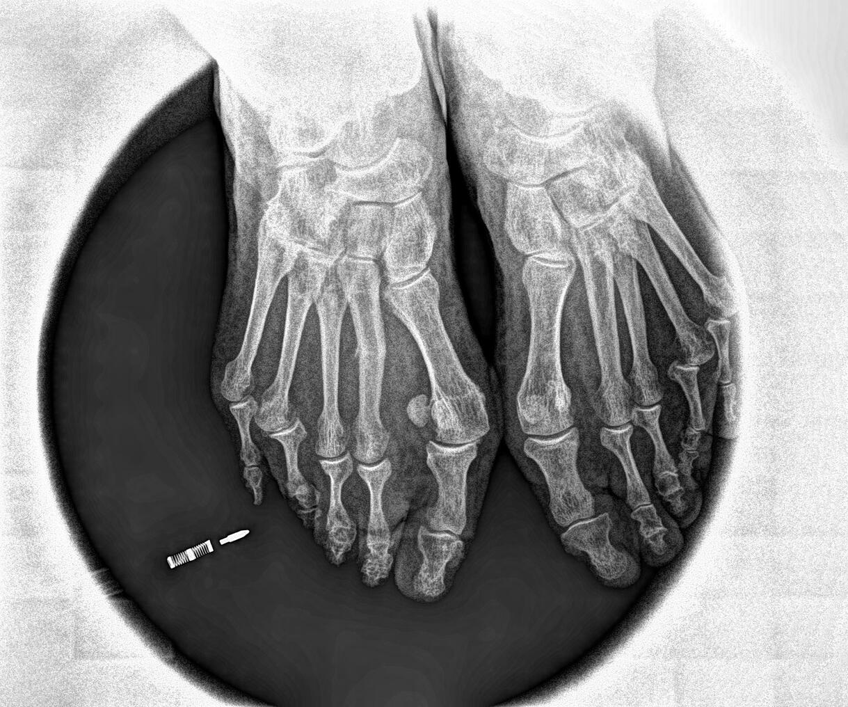 ¿Dolor en metatarsianos = Metatarsalgia? Caso Clínico Real en Santander y Palencia 1 Fractura por estres en paciente con diagnóstico previo de metatarsalgia